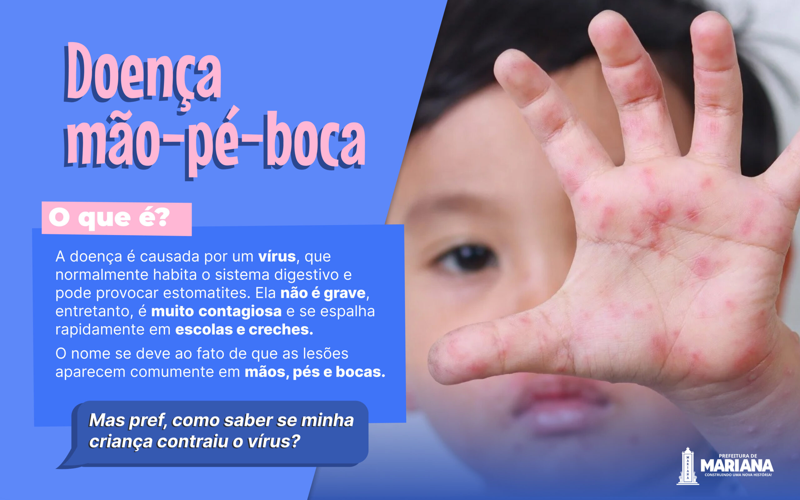 Prefeitura de Mariana reforça a atenção sobre a doença mão-pé-boca