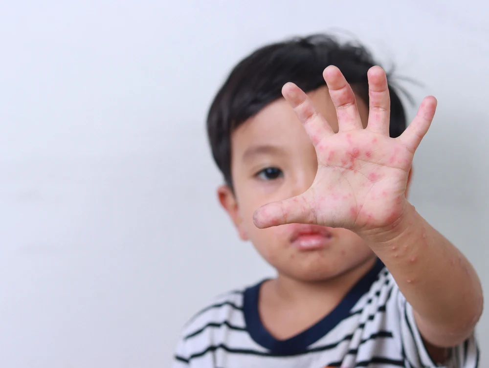 Itabirito agora tem lei para prevenir e controlar a Doença Mão-Pé-Boca em creches e escolas